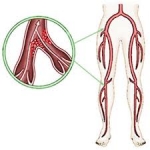 Blood clots, DVTs and Pulmonary Embolism
