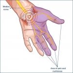 Carpal Tunnel Syndrome, Part 1