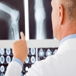 Common Knee Injury Linked to Knee Arthritis