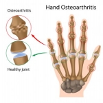 Hand Arthritis: There’s things that can be done!