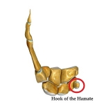 Hook of the Hamate Fracture