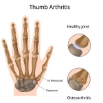 I have thumb arthritis. Now what?!