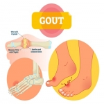 Is it Gout or Rheumatoid Arthritis?