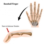 Mallet Finger: How to wash and not ruin recovery