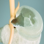 Nerve Root Impingement