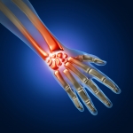 Rheumatoid Vs. Osteoarthritis: What Type of Arthritis Do I Have?