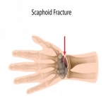 Scaphoid Fractures