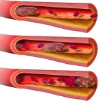 Signs of a Blood Clot