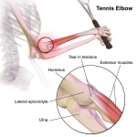 Tennis Elbow: The stubborn Visitor